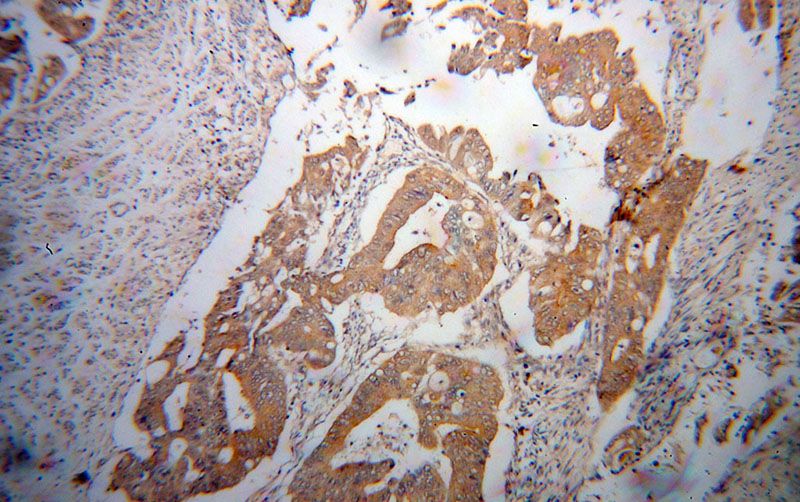 Immunohistochemical of paraffin-embedded human colon cancer using Catalog No:112987(MYO7B antibody) at dilution of 1:50 (under 10x lens)