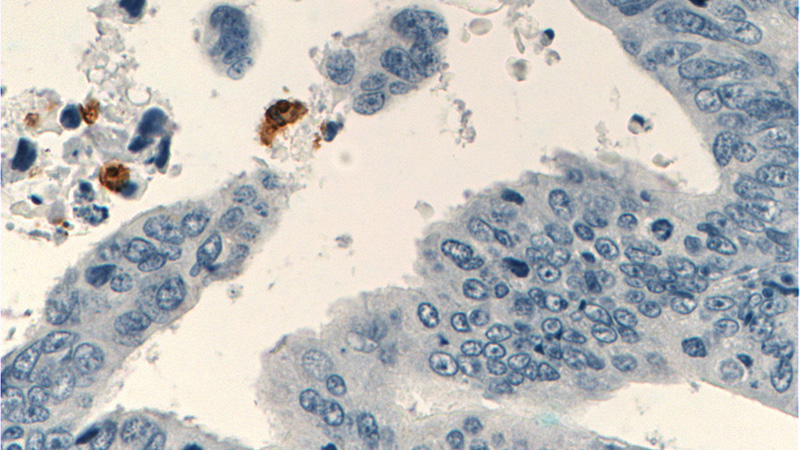 Immunohistochemistry of paraffin-embedded human colon cancer tissue slide using Catalog No:115950(TESC Antibody) at dilution of 1:200 (under 40x lens).
