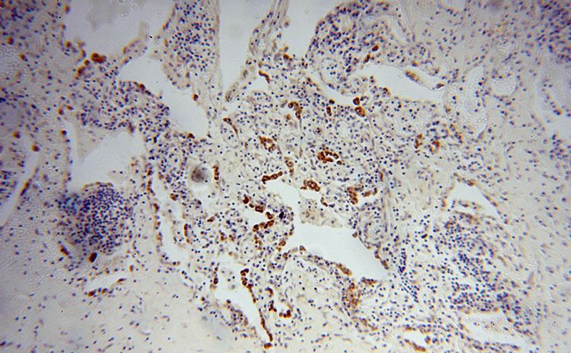 Immunohistochemical of paraffin-embedded human lung cancer using Catalog No:110728(FMO2 antibody) at dilution of 1:100 (under 10x lens)