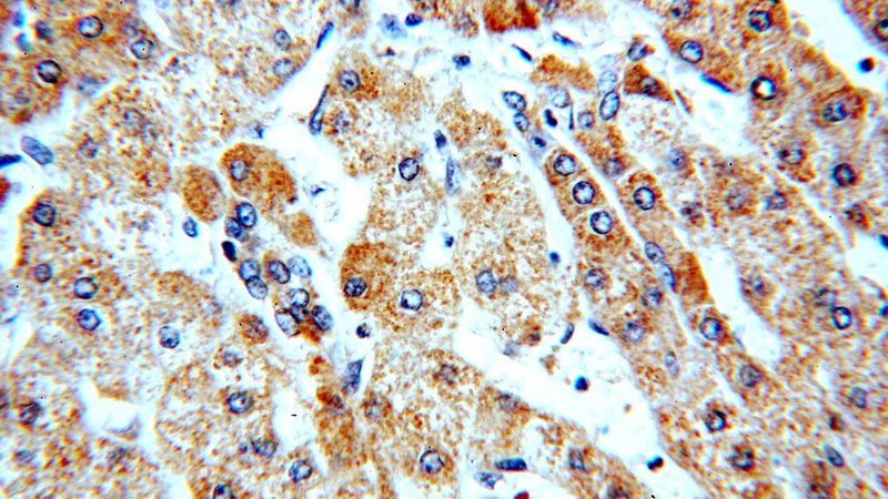 Immunohistochemical of paraffin-embedded human hepatocirrhosis using Catalog No:109688(CYP26B1 antibody) at dilution of 1:50 (under 40x lens)