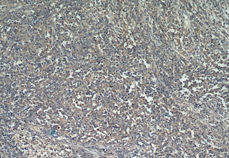 Immunohistochemical of paraffin-embedded human lymphoma using Catalog No:110621(FERMT3 antibody) at dilution of 1:50 (under 10x lens)