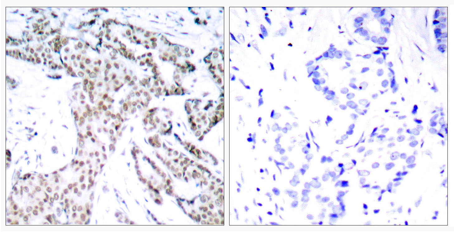Immunohistochemical analysis of paraffin-embedded human breast carcinoma tissue using STAT3 (Phospho-Ser727) Antibody (left) or the same antibody preincubated with blocking peptide (right).