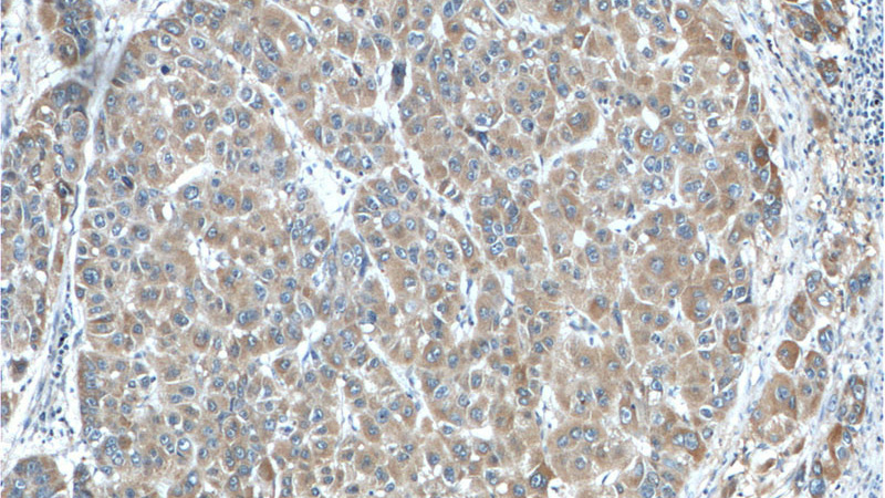 Immunohistochemistry of paraffin-embedded human liver cancer tissue slide using Catalog No:107744(ACOT12 Antibody) at dilution of 1:50 (under 10x lens)