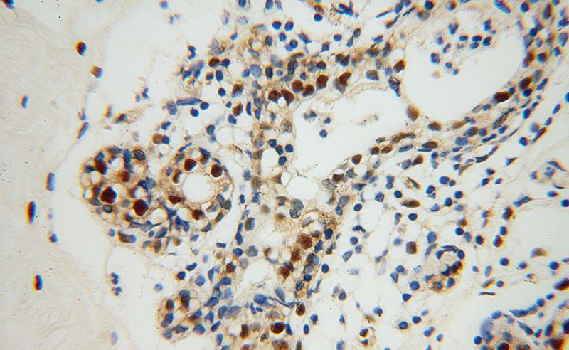Immunohistochemical of paraffin-embedded human colon cancer using Catalog No:116876(XRCC5 antibody) at dilution of 1:100 (under 40x lens)