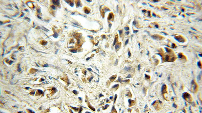 Immunohistochemical of paraffin-embedded human prostate cancer using Catalog No:110176(EIF1AY antibody) at dilution of 1:50 (under 10x lens)