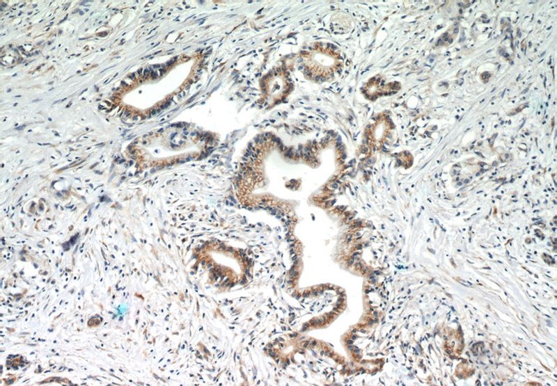 Immunohistochemistry of paraffin-embedded human pancreas cancer slide using Catalog No:107250(EEF1D Antibody) at dilution of 1:50