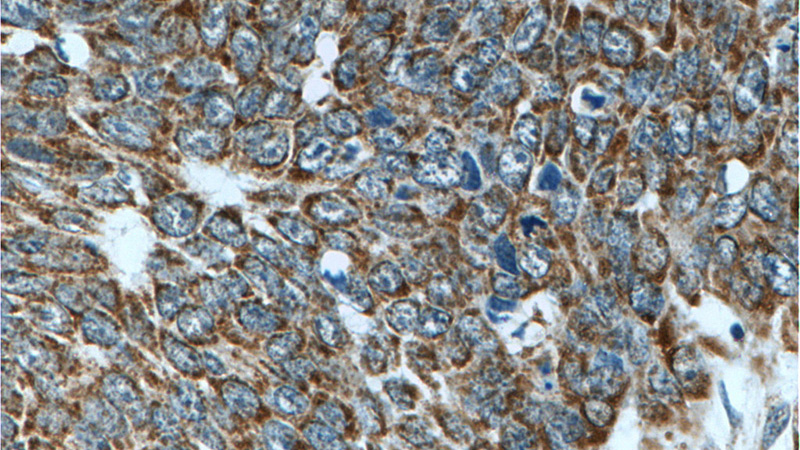 Immunohistochemistry of paraffin-embedded human skin cancer tissue slide using Catalog No:111606(IDH3G Antibody) at dilution of 1:50 (under 40x lens)