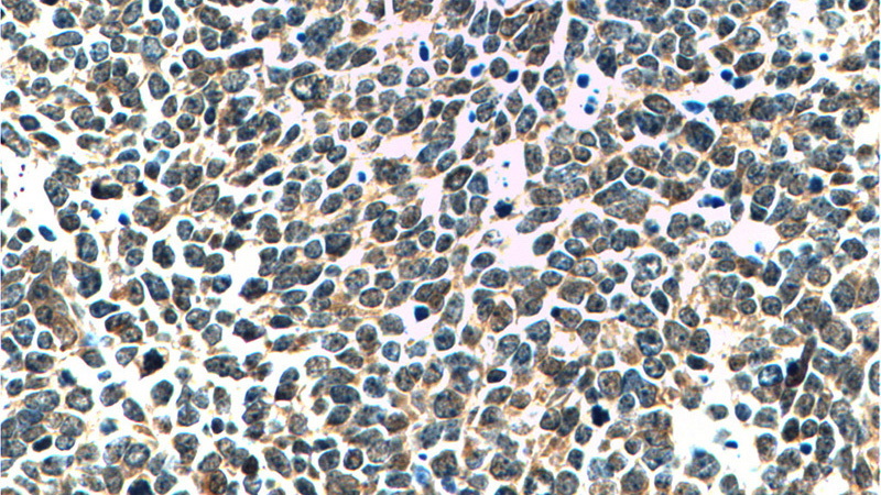 Immunohistochemistry of paraffin-embedded human lung cancer tissue slide using Catalog No:113538(P16-INK4A Antibody) at dilution of 1:200 (under 40x lens).