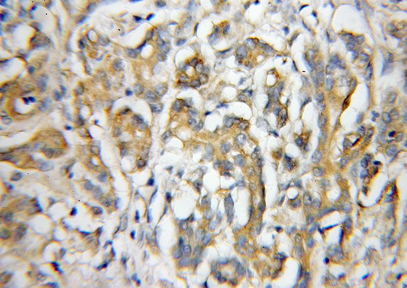 Immunohistochemical of paraffin-embedded human pancreas cancer using Catalog No:111767(IL17RE antibody) at dilution of 1:50 (under 10x lens)