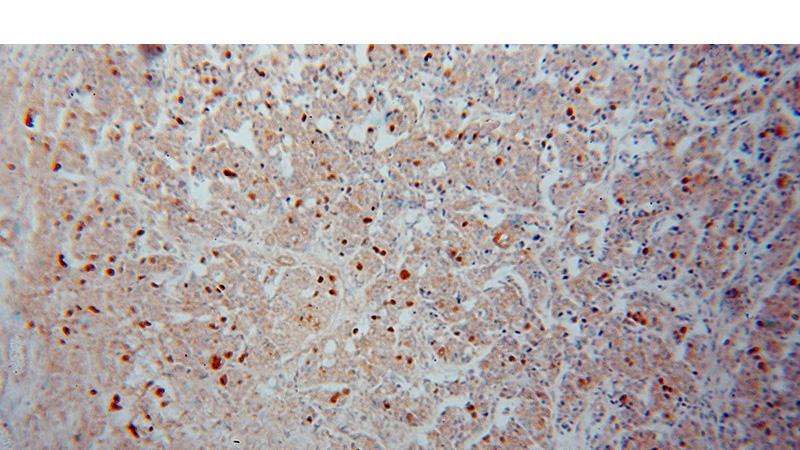 Immunohistochemical of paraffin-embedded human breast cancer using Catalog No:114169(PRC1 antibody) at dilution of 1:50 (under 10x lens)