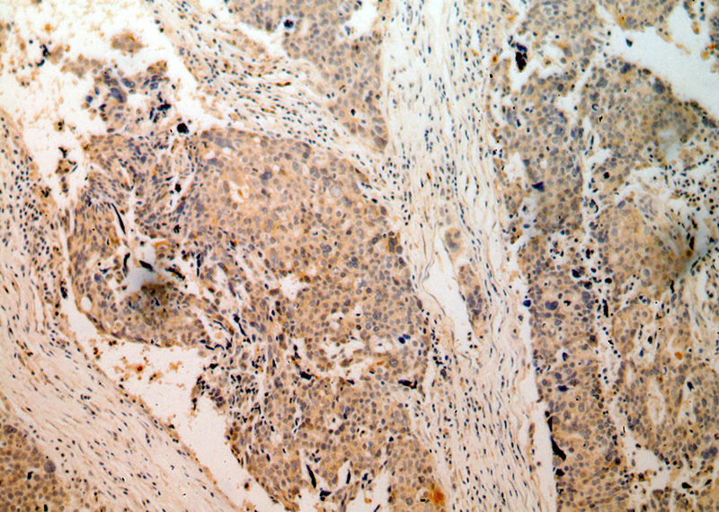 Immunohistochemical of paraffin-embedded human ovary tumor using Catalog No:114844(RPS3 antibody) at dilution of 1:50 (under 10x lens)