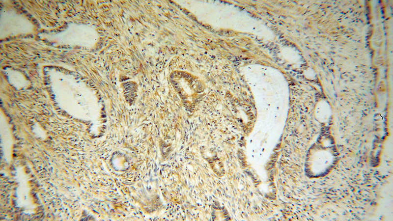 Immunohistochemical of paraffin-embedded human colon cancer using Catalog No:114832(RPS19 antibody) at dilution of 1:100 (under 10x lens)