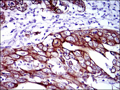 Immunohistochemical analysis of paraffin-embedded stomach cancer tissues using CK5 mouse mAb with DAB staining.