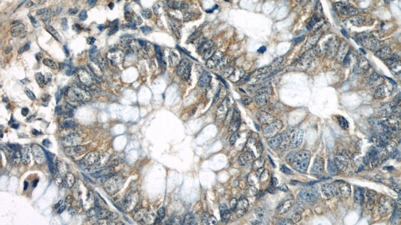 Immunohistochemical of paraffin-embedded human colon using Catalog No:108182(ARHGEF1 antibody) at dilution of 1:50 (under 40x lens)
