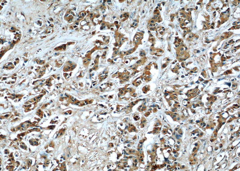 Immunohistochemical of paraffin-embedded human breast cancer using Catalog No:107246(ECM1 antibody) at dilution of 1:50 (under 10x lens)