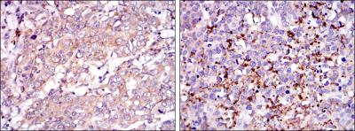 Immunohistochemical analysis of paraffin-embedded stomach cancer tissues (left) and brain tumor (right) using SMN1 mouse mAb with DAB staining.