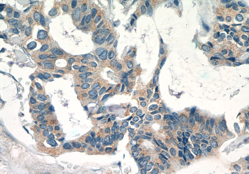 Immunohistochemistry of paraffin-embedded human breast cancer tissue slide using Catalog No:110192(EIF3D Antibody) at dilution of 1:50 (under 40x lens)