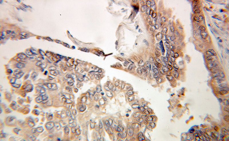 Immunohistochemical of paraffin-embedded human ovary tumor using Catalog No:111639(NFKBIA antibody) at dilution of 1:100 (under 25x lens)