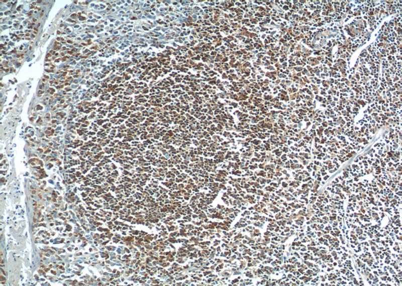 Immunohistochemistry of paraffin-embedded human tonsillitis tissue slide using Catalog No:108265(ARHGAP25 Antibody) at dilution of 1:200 (under 10x lens)