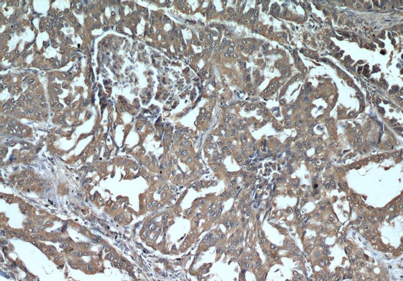Immunohistochemical of paraffin-embedded human lung cancer using Catalog No:107277(IFITM3 antibody) at dilution of 1:50 (under 10x lens)
