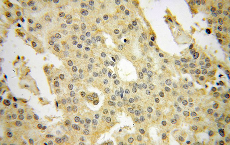 Immunohistochemical of paraffin-embedded human prostate cancer using Catalog No:108250(ARFGAP1 antibody) at dilution of 1:100 (under 40x lens)