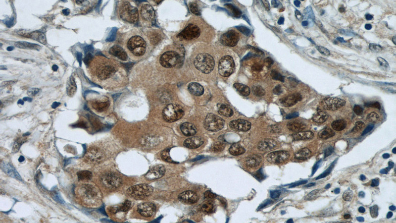 Immunohistochemical of paraffin-embedded human breast cancer using Catalog No:109593(CSE1L antibody) at dilution of 1:50 (under 40x lens)