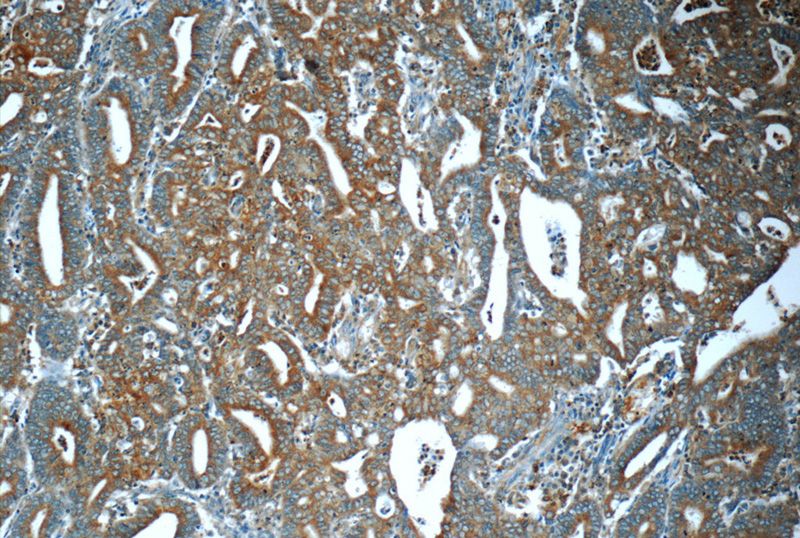 Immunohistochemistry of paraffin-embedded human endometrial cancer tissue slide using Catalog No:112642(MEK1 Antibody) at dilution of 1:50 (under 10x lens)