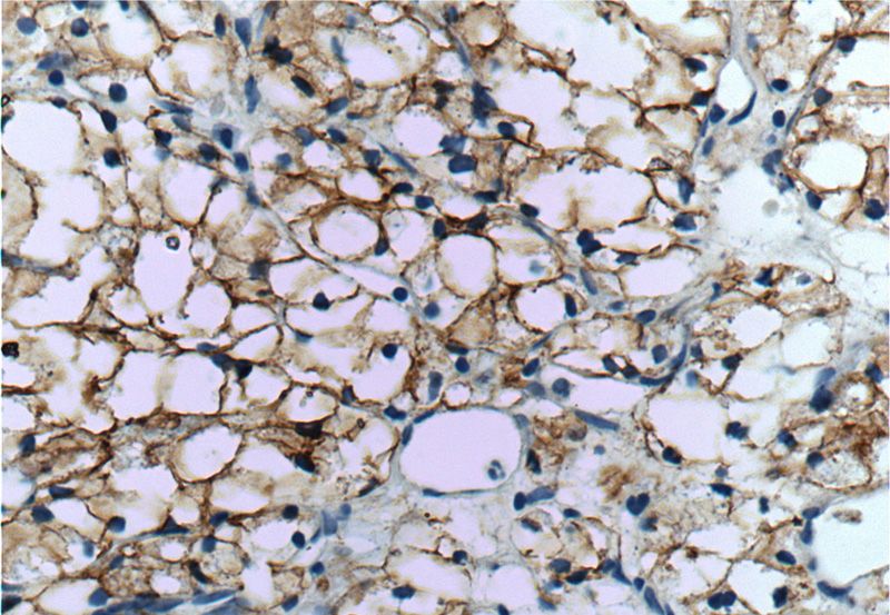 Immunohistochemistry of paraffin-embedded human renal cell carcinoma tissue slide using Catalog No:108740(CA9 Antibody) at dilution of 1:50 (under 40x lens)