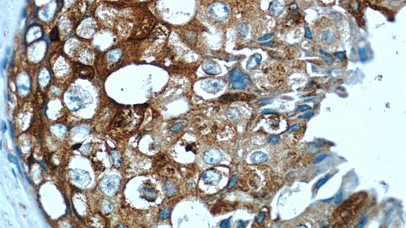 Immunohistochemistry of paraffin-embedded human breast cancer tissue slide using Catalog No:112604(MGP Antibody) at dilution of 1:50 (under 40x lens)