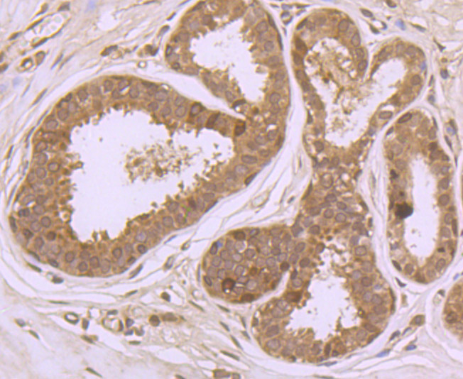 Fig4: Immunohistochemical analysis of paraffin-embedded human breast tissue using anti-PFAS antibody. Counter stained with hematoxylin.