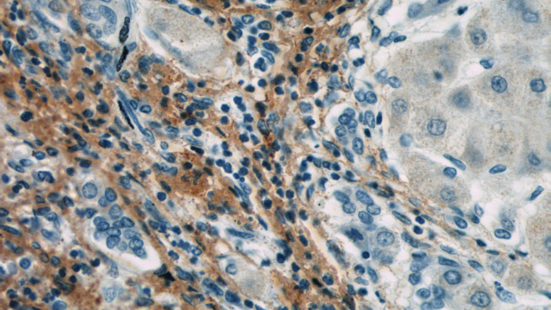 Immunohistochemistry of paraffin-embedded human hepatocirrhosis slide using Catalog No:107213(FMOD Antibody) at dilution of 1:50