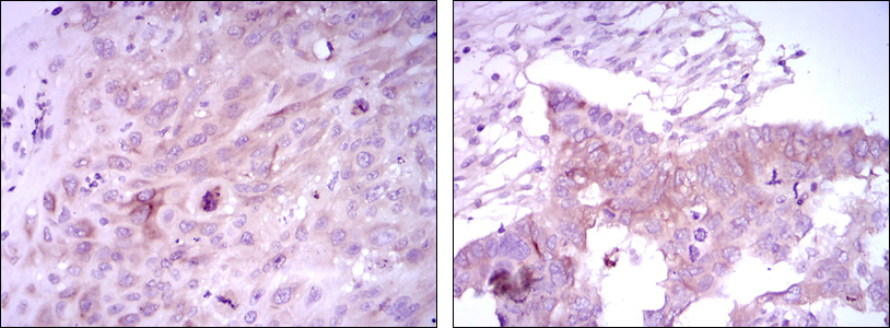 Immunohistochemical analysis of paraffin-embedded lung cancer tissues (left) and ovarian cancer tissues (right) using FOXD3 mouse mAb with DAB staining.