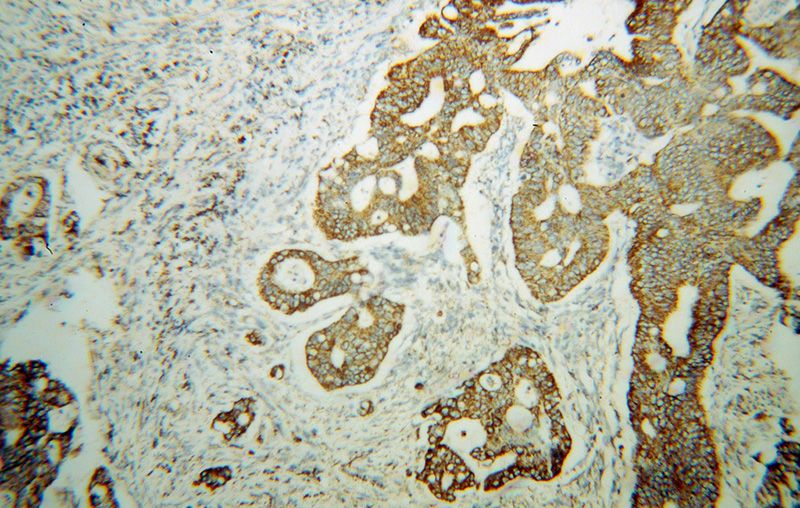 Immunohistochemical of paraffin-embedded human colon cancer using Catalog No:116636(UQCRC2 antibody) at dilution of 1:100 (under 10x lens)