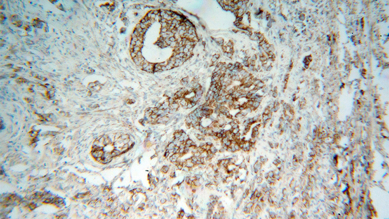 Immunohistochemical of paraffin-embedded human gliomas using Catalog No:113984(PNPT1 antibody) at dilution of 1:100 (under 10x lens)