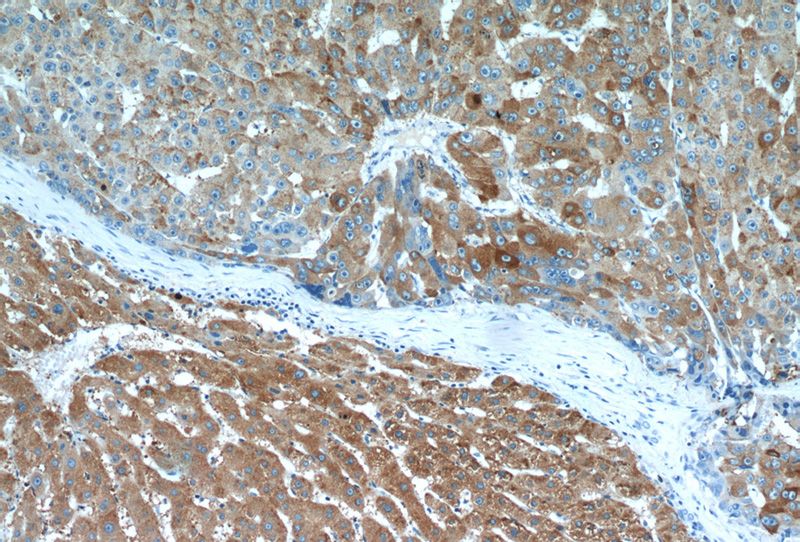 Immunohistochemical of paraffin-embedded human liver cancer using Catalog No:114562(RBP4 antibody) at dilution of 1:50 (under 10x lens)