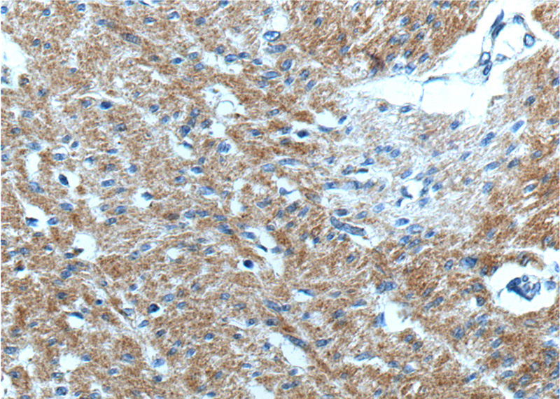 Immunohistochemistry of paraffin-embedded human colon cancer tissue slide using Catalog No:115385(C11orf75 Antibody) at dilution of 1:200 (under 10x lens).