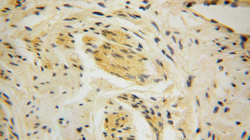 Immunohistochemical of paraffin-embedded human cervical cancer using Catalog No:116578(UROS antibody) at dilution of 1:50 (under 40x lens)
