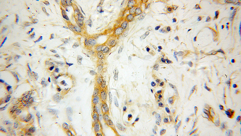 Immunohistochemical of paraffin-embedded human pancreas cancer using Catalog No:113041(NCLN antibody) at dilution of 1:50 (under 40x lens)