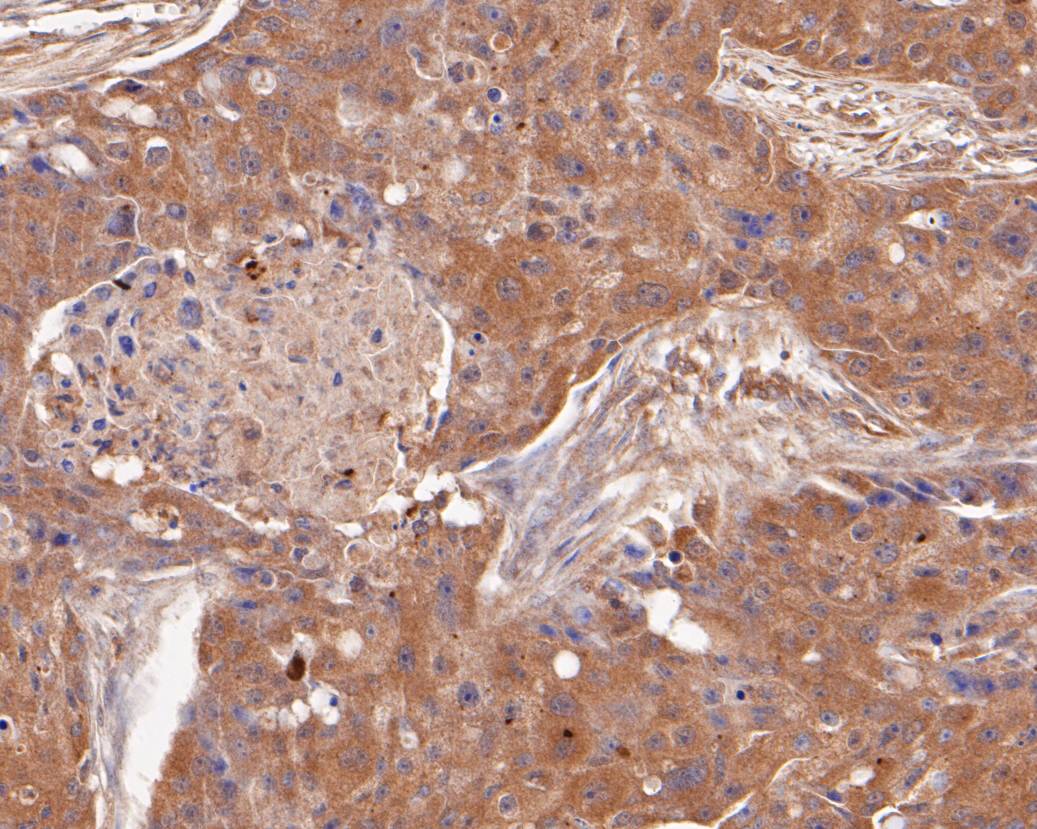 Fig4: Immunohistochemical analysis of paraffin-embedded human breast carcinoma tissue using anti-SPATIAL antibody. The section was pre-treated using heat mediated antigen retrieval with Tris-EDTA buffer (pH 8.0-8.4) for 20 minutes.The tissues were blocked in 5% BSA for 30 minutes at room temperature, washed with ddH2O and PBS, and then probed with the primary antibody ( 1/50) for 30 minutes at room temperature. The detection was performed using an HRP conjugated compact polymer system. DAB was used as the chromogen. Tissues were counterstained with hematoxylin and mounted with DPX.