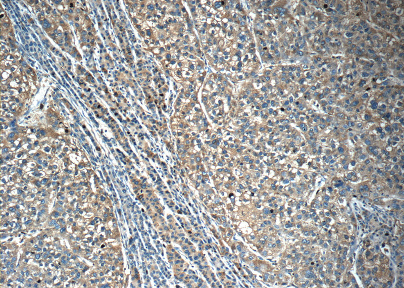 Immunohistochemistry of paraffin-embedded human liver cancer tissue slide using Catalog No:113340(OLFM3 Antibody) at dilution of 1:50 (under 10x lens)