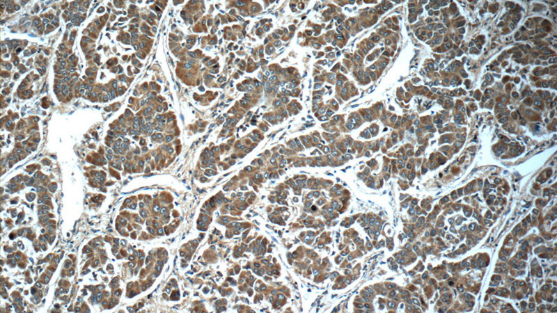 Immunohistochemistry of paraffin-embedded human liver cancer slide using Catalog No:111456(HPSE Antibody) at dilution of 1:50