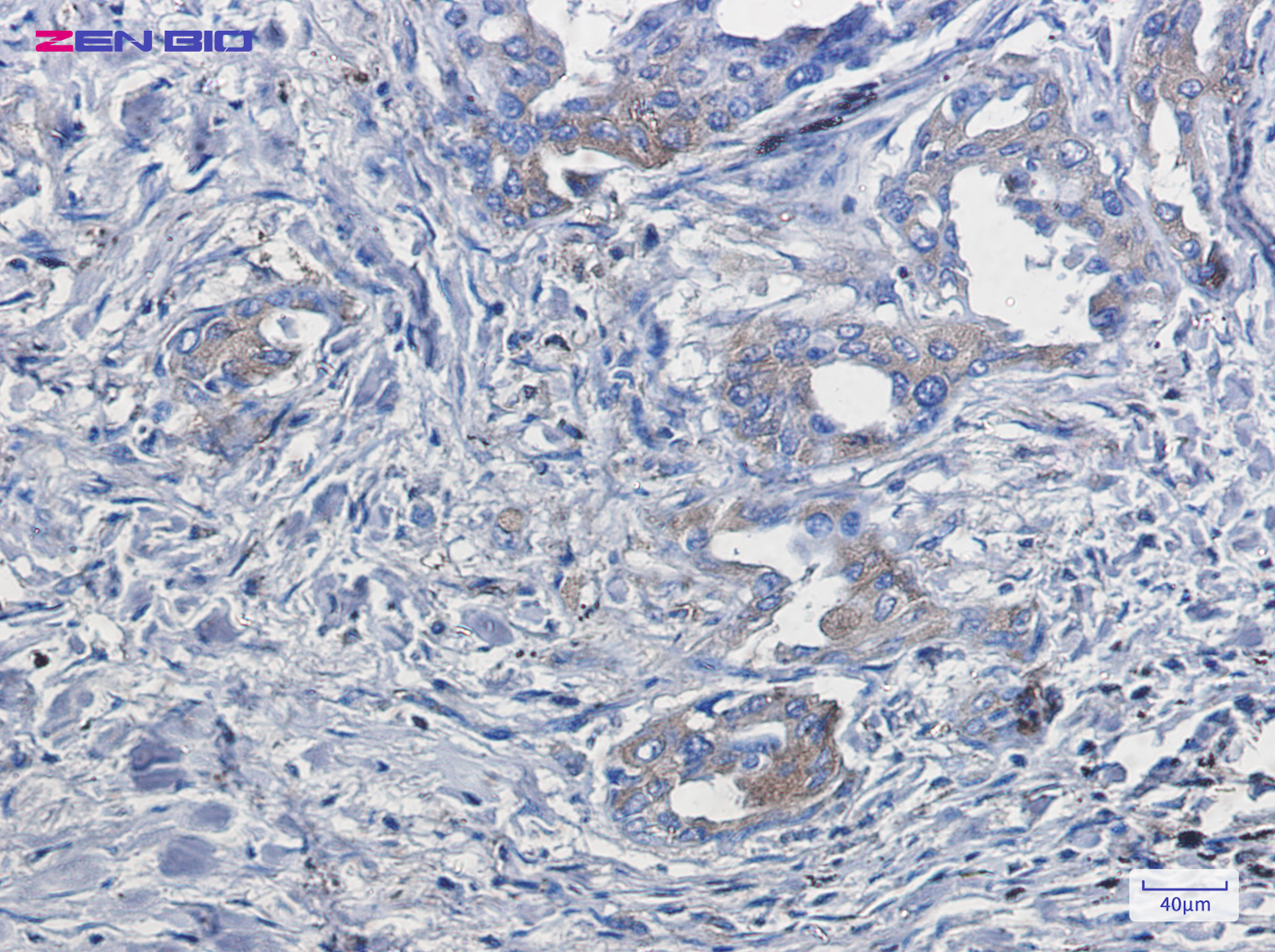 Immunohistochemistry of Tetranectin in paraffin-embedded Human lung cancer tissue using Tetranectin Rabbit pAb at dilution 1/50