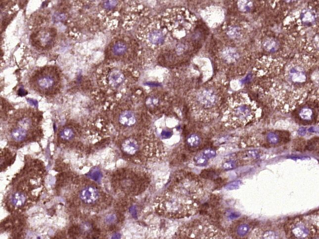 Fig4: Paraformaldehyde-fixed, paraffin embedded (Human liver cancer); Antigen retrieval by boiling in sodium citrate buffer (pH6.0) for 15min; Block endogenous peroxidase by 3% hydrogen peroxide for 20 minutes; Blocking buffer (normal goat serum) at 37℃ for 30min; Antibody incubation with (BTBD17) Polyclonal Antibody, Unconjugated at 1:400 overnight at 4℃, followed by operating according to SP Kit(Rabbit) (sp-0023) instructionsand DAB staining.