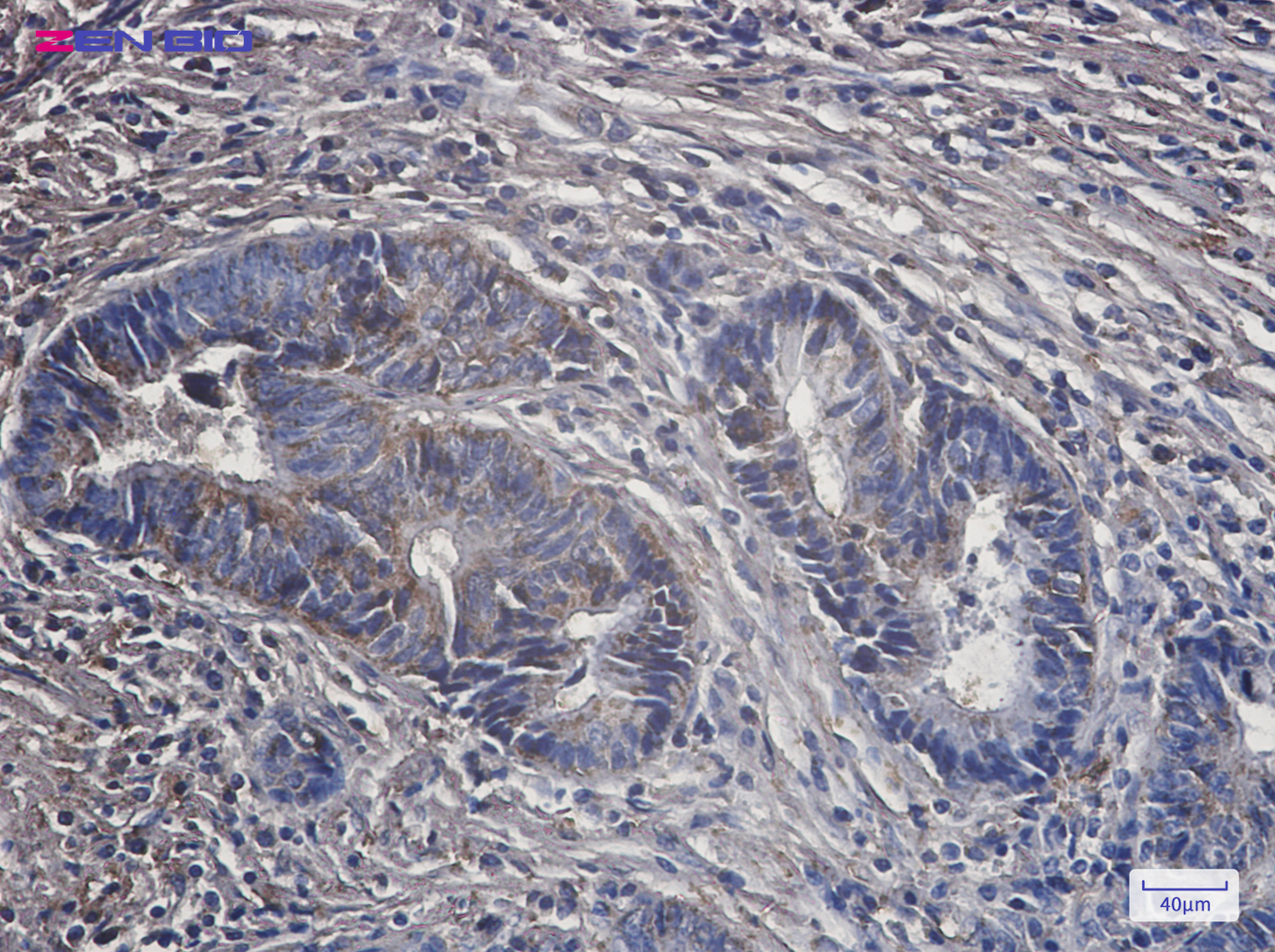 Immunohistochemistry of PCK2 in paraffin-embedded Human colon cancer tissue using PCK2 Rabbit pAb at dilution 1/50