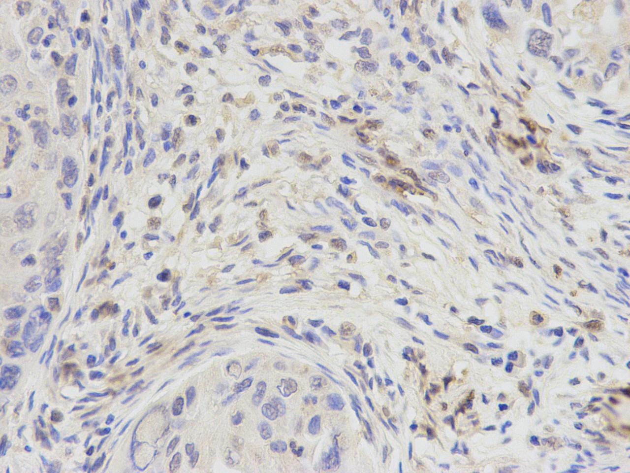 Fig3: Immunohistochemical analysis of paraffin-embedded human lung carcinoma tissue using anti- DPY30 rabbit polyclonal antibody.