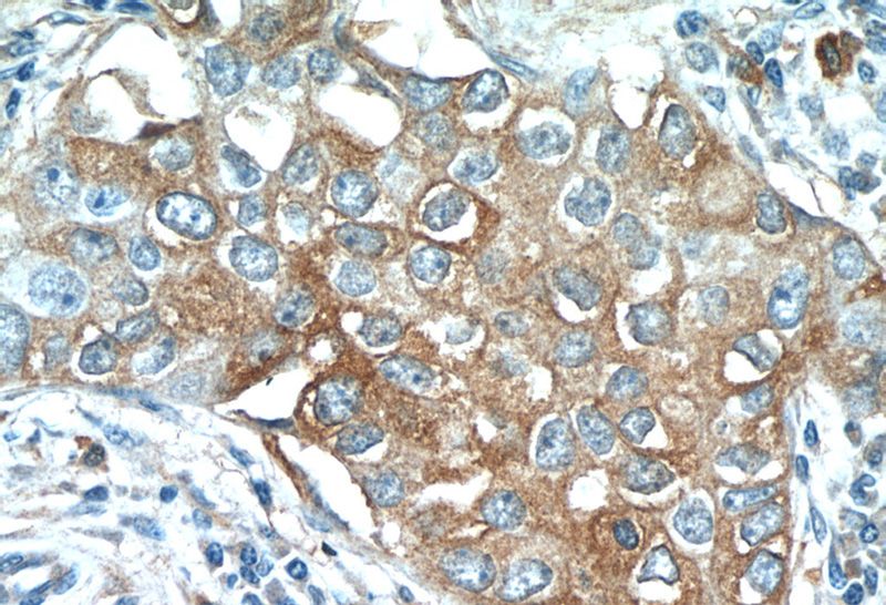 Immunohistochemistry of paraffin-embedded human breast cancer tissue slide using Catalog No:116198(TMEM87A Antibody) at dilution of 1:50 (under 40x lens)