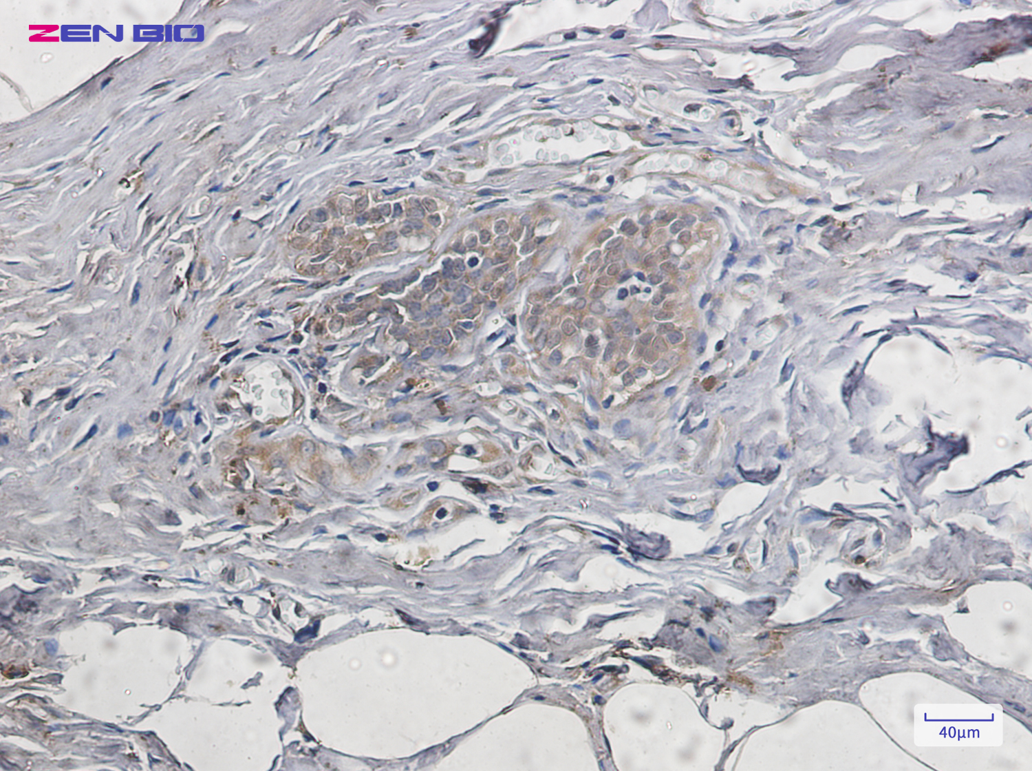 Immunohistochemistry of PUMA in paraffin-embedded Human breast cancer tissue using PUMA Rabbit pAb at dilution 1/20