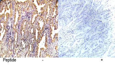 Immunohistochemical analysis of paraffin- embedded human lung carcinoma tissue using STAT3 (Ab-727) antibody.