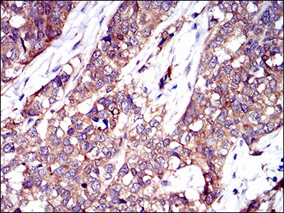 Immunohistochemical analysis of paraffin-embedded bladder cancer tissues using TWF1 mouse mAb with DAB staining.