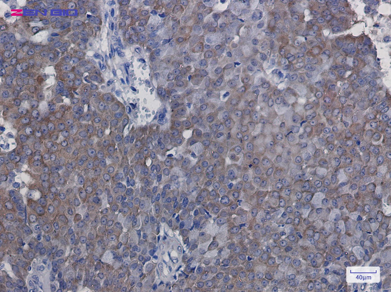 Immunohistochemistry of eIF5A in paraffin-embedded Human breast cancer tissue using eIF5A Rabbit pAb at dilution 1/100